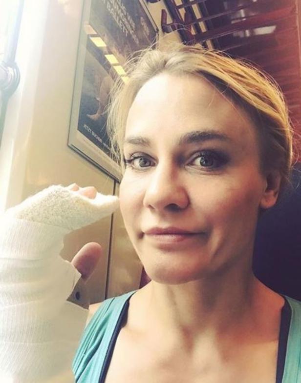 Mittelhandknochen-Bruch: Nicole Wesner hat die OP überstanden
