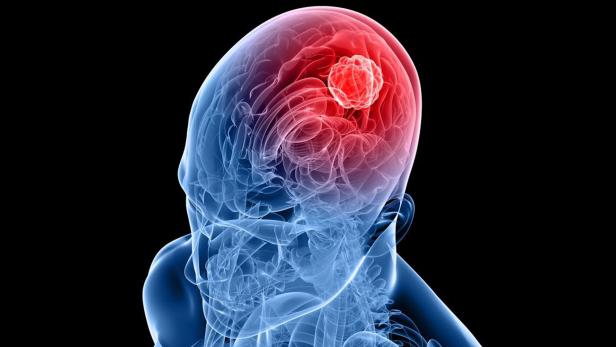 Ein Gehirn mit einem roten Tumor in einer Illustration.