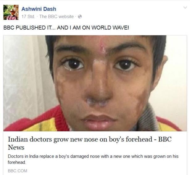 „Indische Ärzte haben einem Jungen eine neue Nase auf der Stirn gezüchtet.“