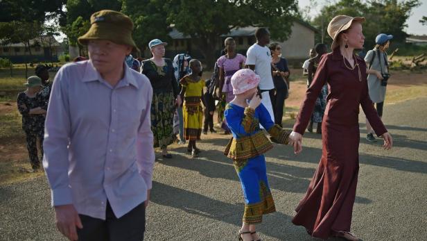 Wo Menschen mit Albinismus vor Verfolgung geschützt sind