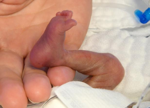 Frühgeborene: Grazer Forscher stärken den Darm gegen Krisen