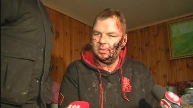 Ein Mann mit Verletzungen im Gesicht spricht in Mikrofone.