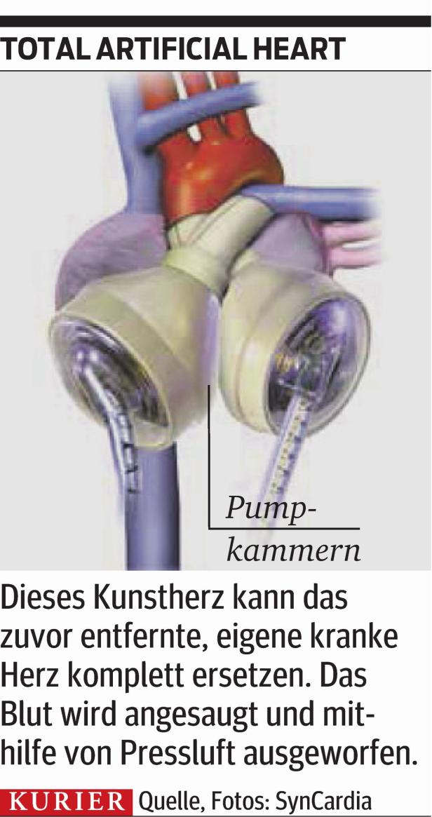 Zuerst Kunstherz, jetzt Spenderherz