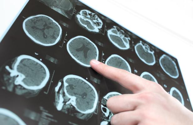 Ein Finger zeigt auf eine Reihe von CT-Scans des menschlichen Gehirns.