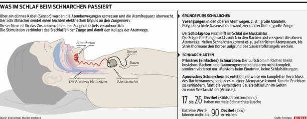 Ein Zungenschrittmacher gegen das Schnarchen