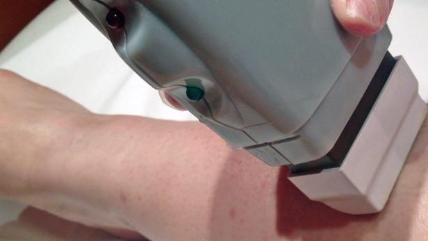 Ein Lasergerät wird auf einem Arm zur Haarentfernung verwendet.