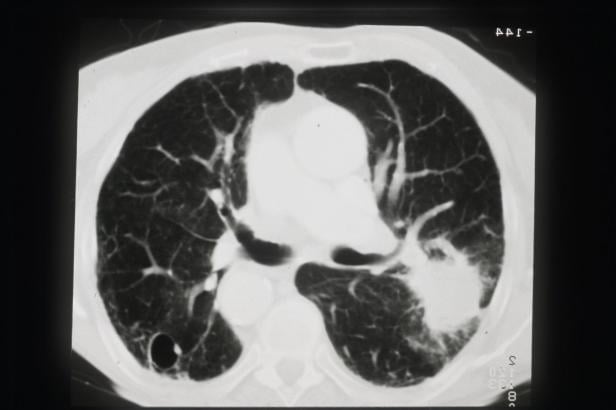 Ein CT-Scan der Lunge zeigt eine mögliche Erkrankung.