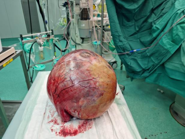 Seltener Fall: Zehn Kilogramm schwerer Tumor bei Kärntnerin entfernt
