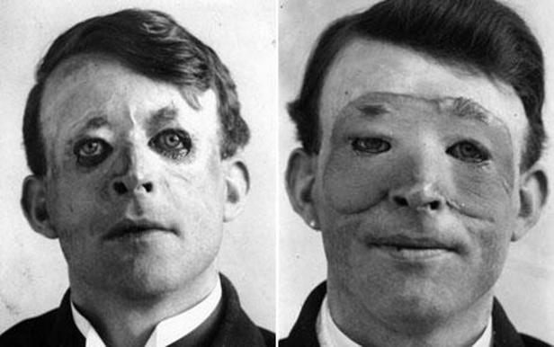 Ein Mann vor und nach einer rekonstruktiven Gesichtsoperation.