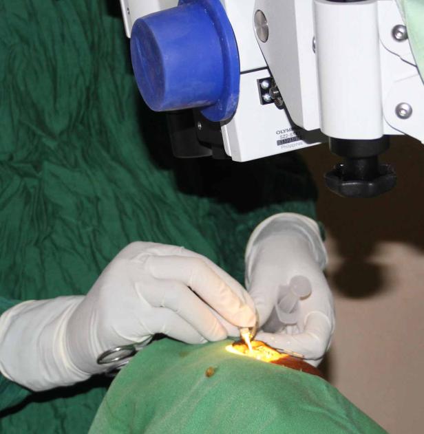 Ein Chirurg führt eine Augenoperation mit Hilfe eines Mikroskops durch.