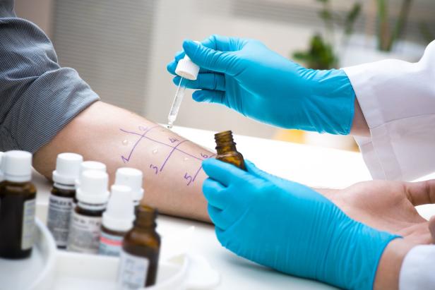 Ein Arzt führt einen Allergietest auf dem Unterarm eines Patienten durch.