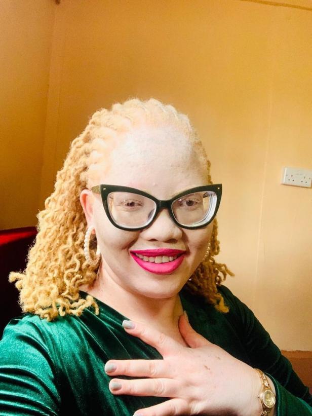 Albinismus in Afrika: Betroffene kämpft gegen Verfolgung und Aberglauben