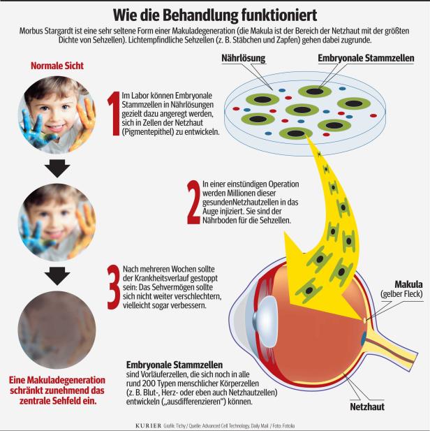 Embryo-Zellen gegen Augenleiden