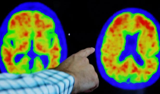 Die zwölf Faktoren, die das Alzheimer-Risiko stark beeinflussen