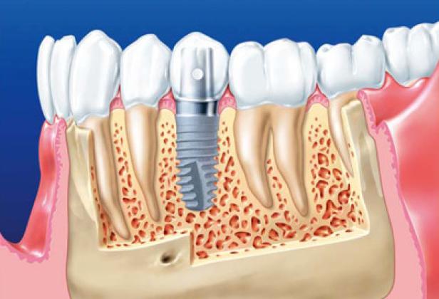 Ein Zahnschema zeigt ein Zahnimplantat im Kieferknochen.
