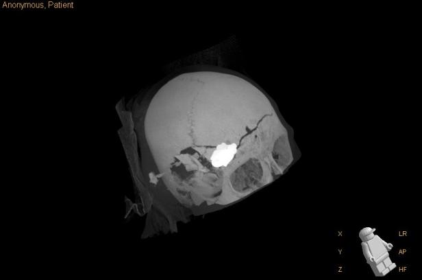 Nach Forstunfall: Bub erhielt Kunststoff-Schädeldecke aus 3D-Drucker