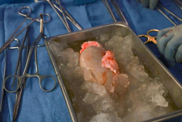 Erstmals Schweineniere einem lebenden Menschen transplantiert