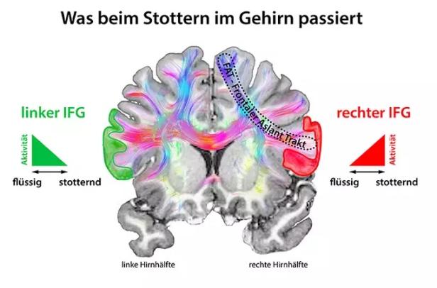 Stottern bei Kindern: Wann es bleibt und wann es verschwindet