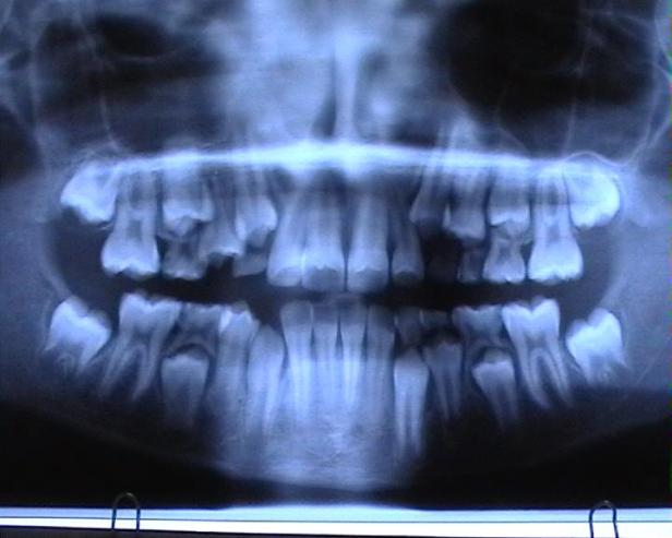 Wie gefährlich ist das Zahnröntgen?