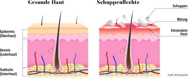 Psoriasis-Therapie: Neue Hoffnung dank Biologika