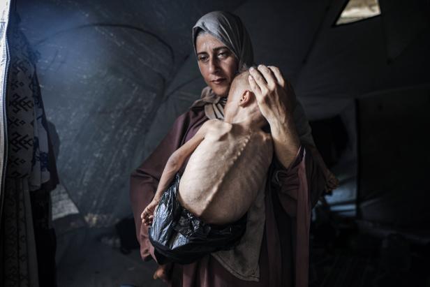 Malnourished toddler in Gaza fights for life amid ongoing Israeli attacks Malnourished toddler in Gaza fights for life amid ongoing Israeli attacks