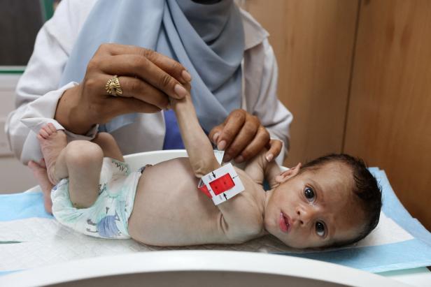 On Gaza malnutrition ward, a child's limb is as wide as a mother's finger in Khan Younis On Gaza malnutrition ward, a child's limb is as wide as a mother's finger in Khan Younis