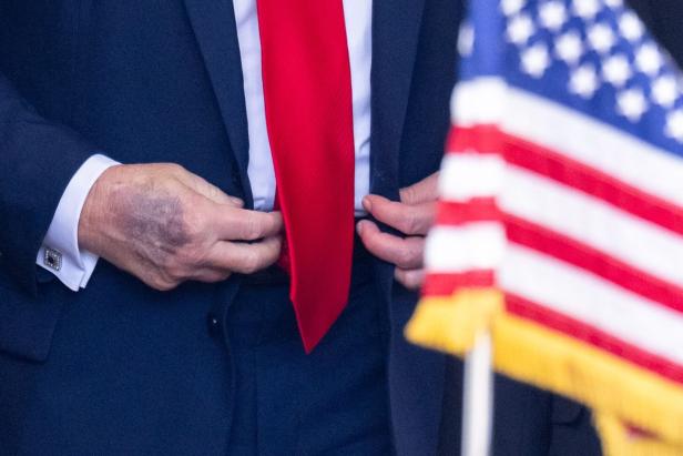 Das Bild zeigt die Hände des US-Präsidenten Donald Trump. Auf dem rechten Handrücken ist deutlich ein Bluterguss zu sehen. 