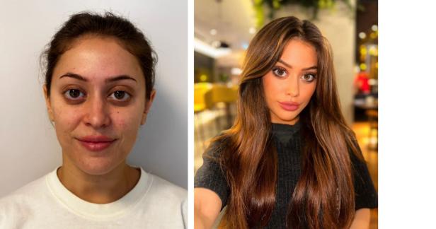 28-Jährige vor und nach ihren Beauty-OPs