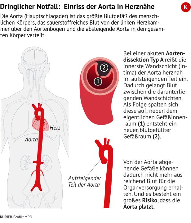 Diese Illustration zeigt, was bei einer Aortendissektion passiert, wie sich die einzelnen Schichten der Hauptschlagader aufspalten.