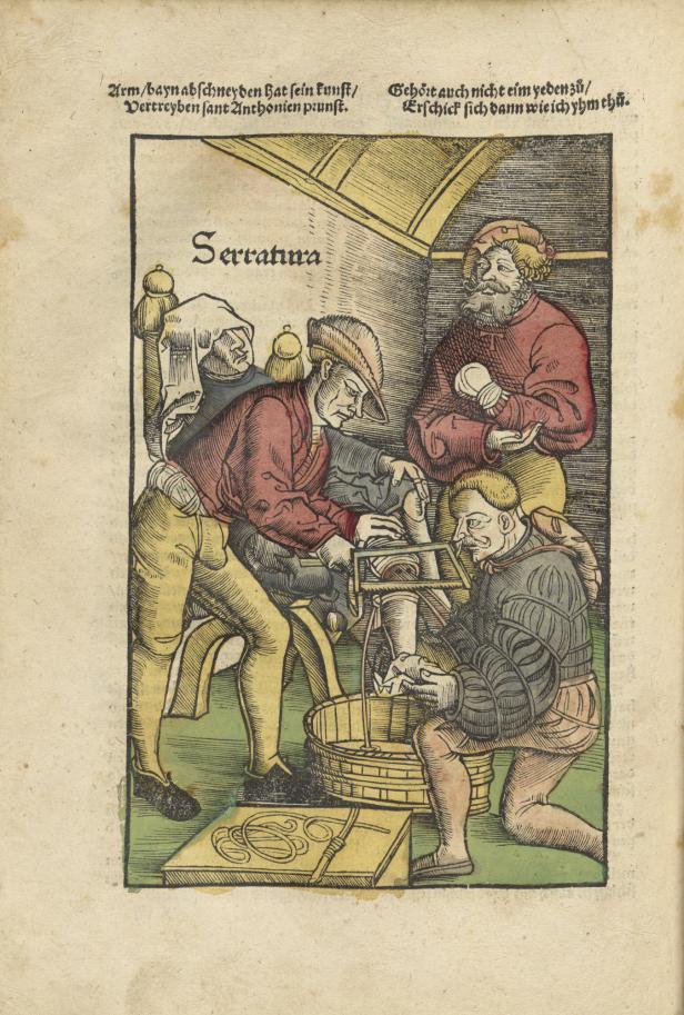 Historische farbige Illustration zeigt drei Männer bei einer Beinamputation, einer hält das Bein, ein anderer arbeitet mit einem Sägewerkzeug, der dritte sitzt daneben mit verbundenem Bein.