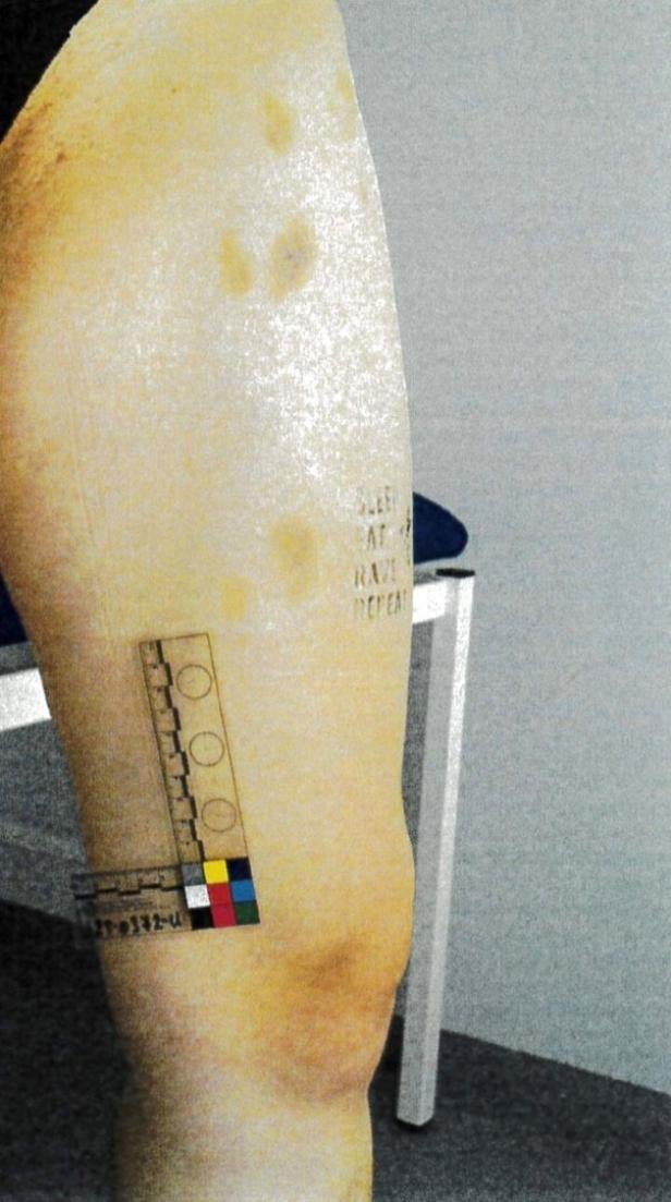 Verletzungen der 23-Jährigen wurden dokumentiert