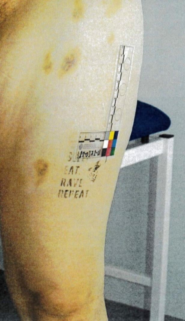 Hämatome an den Oberschenkeln der 23-Jährigen