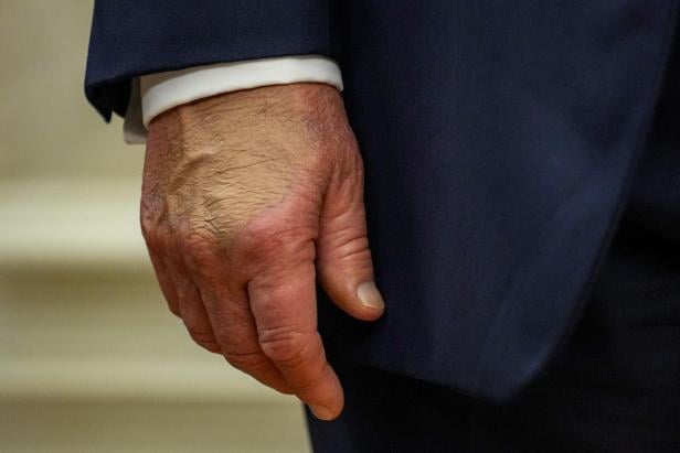 Eine ältere, leicht gerötete Hand mit sichtbaren Adern hängt entspannt an der Seite eines dunkelblauen Anzugs.