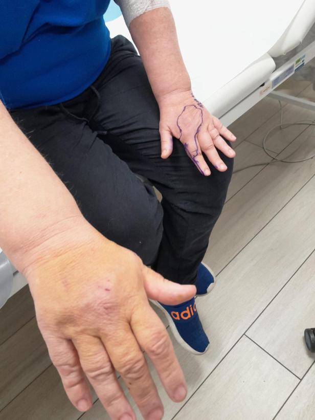 Ortrun G. erlitt Bissverletzungen an beiden Händen. 