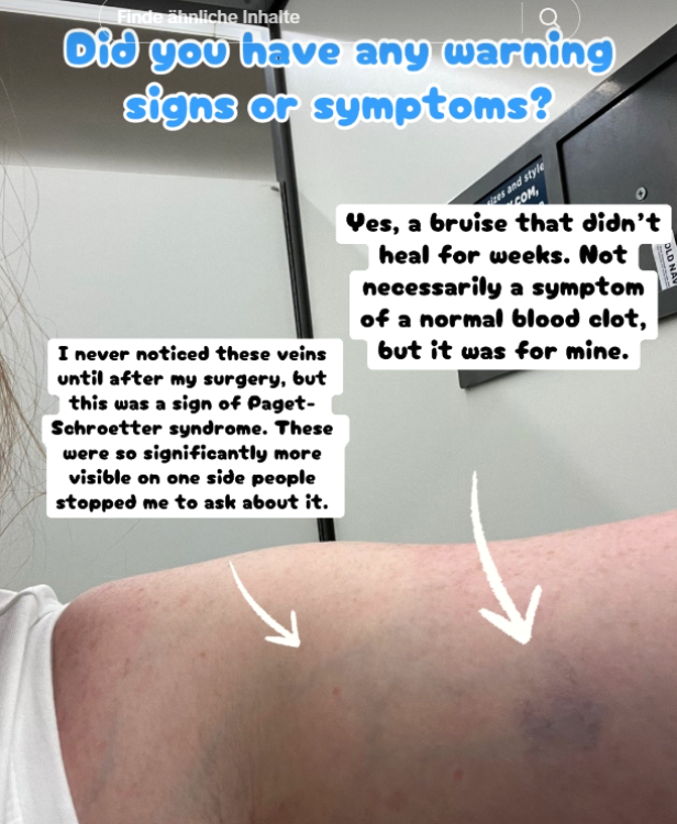 Blauer Fleck am Oberarm