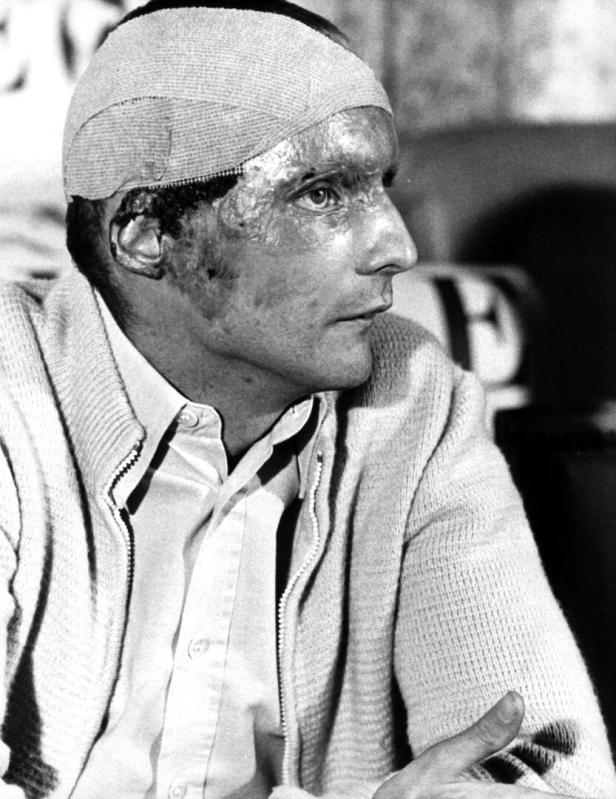 Formula 1- Niki Lauda after his accident 1976