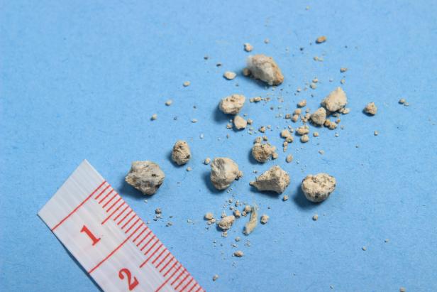 flat lay or top view very small kidney stones with ruler at blue background
