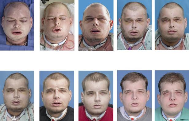 Erfolgreiche Gesichtstransplantation für Mann aus Wyoming