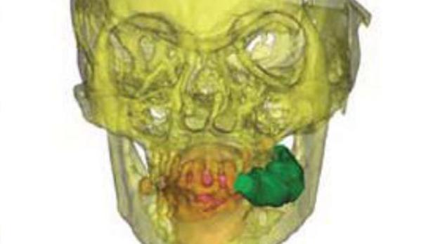 Die 3D-Untersuchung des Schädels zeigt den Koka-Priem im Mund (grün)