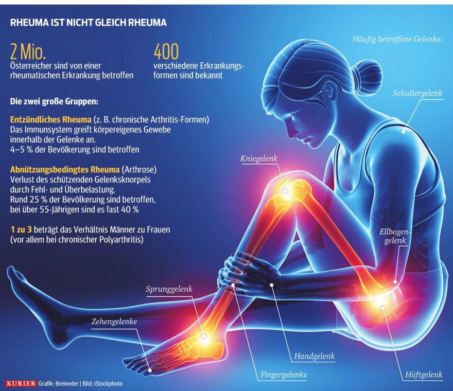 Rheuma: So haben sich die Therapien verbessert