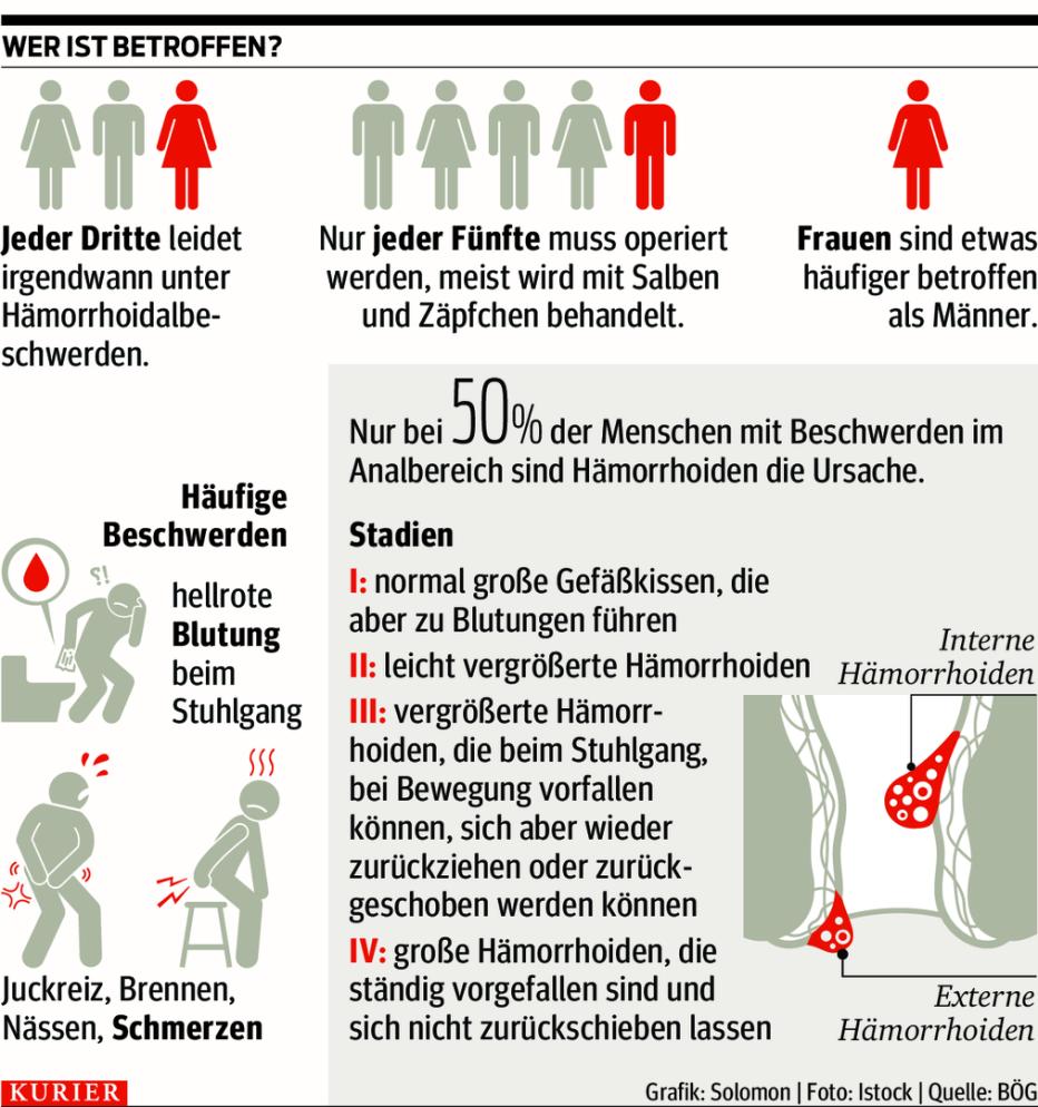 Hämorrhoiden: Was wirklich hilft | Kurier