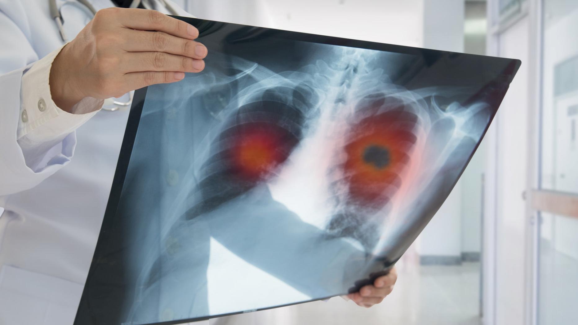 Neue Infos zu LungenkrebsMedikament Besser als nur Chemotherapie