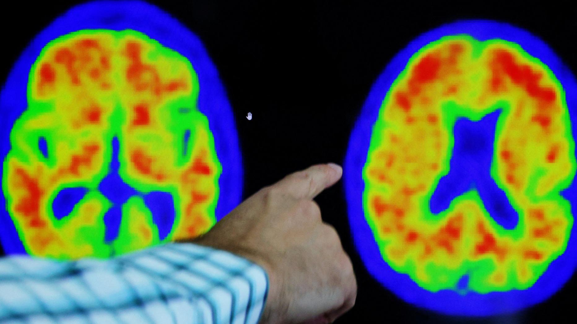 Donanemab, Lecanemab: Was über Die Neuen Alzheimer-Mittel Bekannt Ist