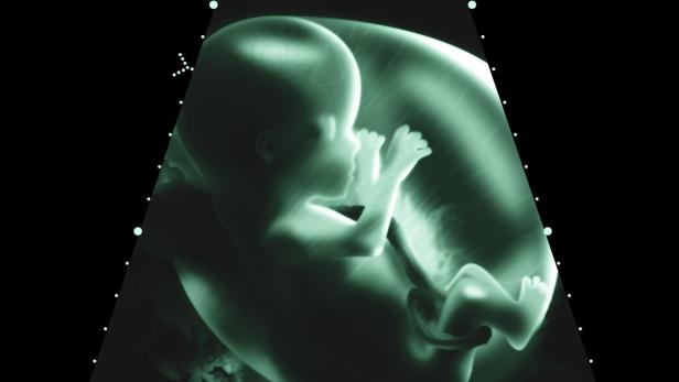 Medizinische Sensation: Baby kam zwei Mal zur Welt