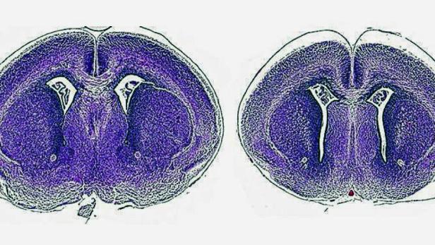Das neu entdeckte Krankheitsbild beeinflusst die Hirnentwicklung: Links ein gesundes Mausgehirn, rechts ein unterentwickeltes.