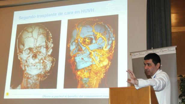Ein Mann präsentiert auf einer Folie Schädel-CT-Scans vor und nach einer Gesichtstransplantation.