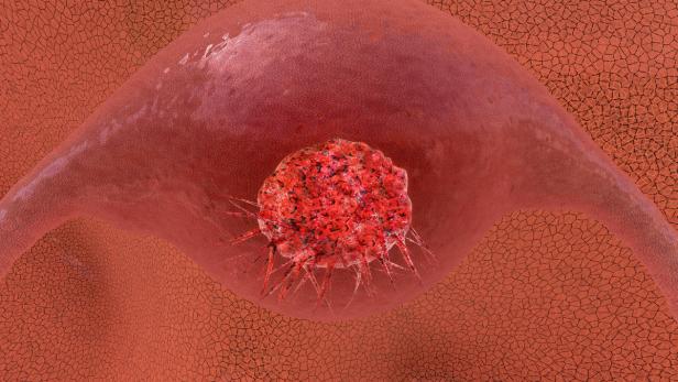 Eine Nahaufnahme eines roten Tumors, der in ein Organ eingebettet ist.