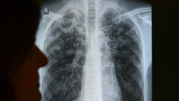 Die Infektionskrankheit Tuberkulose (TB) ist auch in Europa längst nicht ausgerottet. 2013 haben sich schätzungsweise 360 000 Europäer mit der Lungenkrankheit angesteckt. Foto: Rainer Jensen/dpa