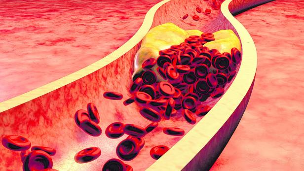 Gelangen die Fettablagerungen (gelb) in den Blutstrom, kann sich ein Gerinnsel bilden.