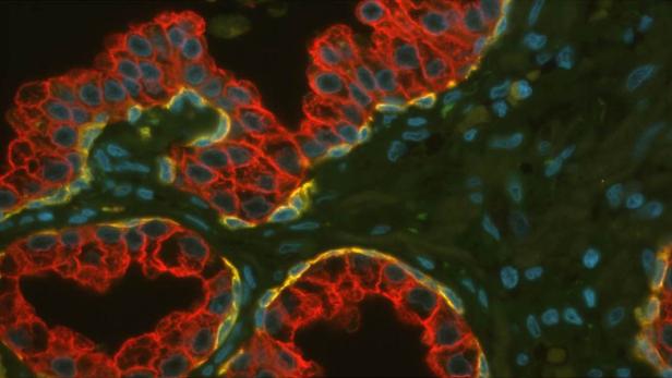 Hellrot oder doch eher orange? Die Rottöne dieser Gewebeprobe unter dem Mikroskop zeigen Krebszellen, die an ihrer Oberfläche ein Merkmal haben, das nur bestimmte Medikamenten erkennen und angreifen (gelb ist gesundes Gewebe, blau sind Zellkerne). Eine Software kann solche Aufnahmen exakter beurteilen als das menschliche Auge